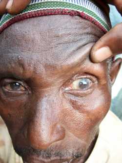 Man blinded by trachoma. CDC photo, Sonia Pelletreau