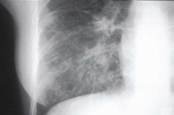 x-ray view of mycoplasm pneumonia
