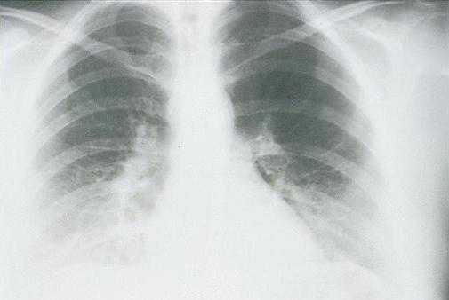 x-ray view of lungs of a patient in the first stage with HPS