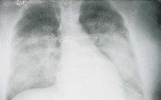 x-ray view of lungs of a patient in the second stage with HPS