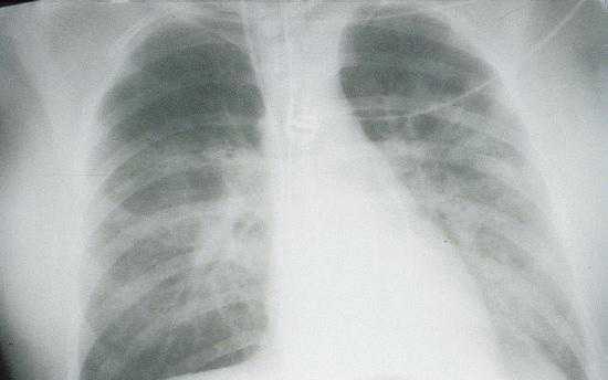x-ray view of lungs of a patient in the third stage with HPS