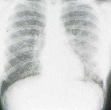 x-ray view of prominent interstitial opacities in mycoplasm pneumonia