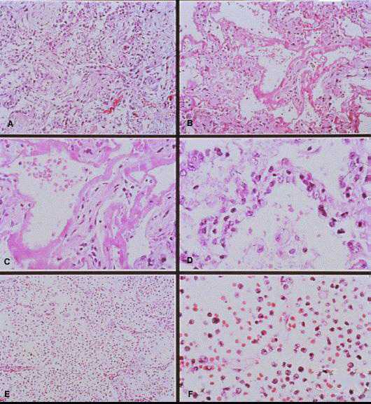 less commonly seen histopathological features in cases of HPS