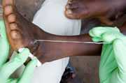 	Extracting guinea worm from a persons leg. Photo The Carter Center.