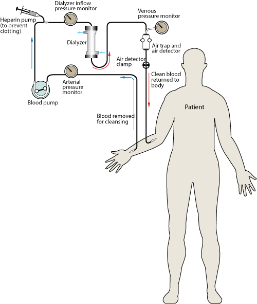 	Figure detailing the process of hemodialysis in a patient: During hemodialysis, blood flows out of the body and by one side of a semi-permeable membrane. Dialysate, the fluid in a dialysis machine, flows by the opposite side of the membrane. Undesired waste in the blood flows into the dialysate, while bicarbonate (a needed solute that helps in pH balance) flows from the dialysate into the blood. The clean blood is then returned to your body. Removing the harmful waste and extra salt and fluids helps control blood pressure, pH balance, and plasma volume, similar to the results of a functioning kidney.