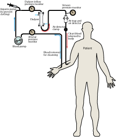 	Figure detailing the process of hemodialysis in a patient