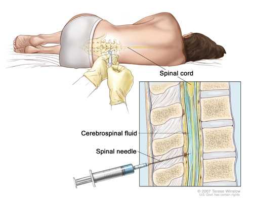 Lumbar puncture to collect sample of cerebrospinal fluid. Copyrighted image
