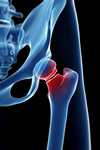 	hip fracture