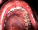 This HIV-positive patient was exhibiting signs of a secondary condyloma acuminata infection, i.e., venereal warts (This intraoral eruption of condyloma acuminata, or venereal warts was caused by the human papilloma virus)
