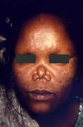 The face of this female patient exhibited some of the complications associated with multibacillary leprosy. Of note was the depressed nasal bridge known as saddle-nose deformity due to the disintegration of the nasal cartilage in this area. Also note the lack of eyebrows and the mottled coloration of the sclerae bilaterally.