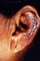 This patient presented to a clinical setting with an inflammatory lesion on the outer left ear, or pinna, which having undergone a differential diagnosis, was determined to be the paucibacillary form of Hansen’s disease. Eliminated as possible pathologic processes were lupus vulgaris and eczematous dermatitis.