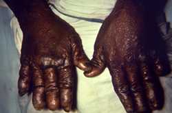This image depicts the dorsal surface of the hands of a patient with a case of nodular multibacillary leprosy. The digits of both hands had been eroded over the course of the illness, and the skin exhibited numerous cutaneous nodules, which were indicative of late-stage disease. 