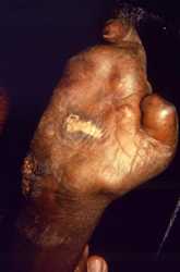 This image depicts the ventral surface of the right hand of a patient with a case of multibacillary leprosy. At this late stage, the digits have been almost fully resorbed, except for the index finger, and the proximal remnant of the thumb. There is also a granulomatous inflammatory lesion located on the palmar surface.