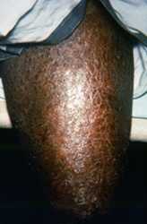 Multibacillary leprosy
