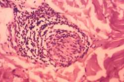 This photomicrograph reveals some of the classic histopathologic changes found in a skin section from an individual with a case of the leprosy, which may have been the paucibacillary form of the disease, though this has not been confirmed. Shown here is a nerve surrounded by a dense infiltrate consisting of undifferentiated histiocytes and large numbers of lymphocytes. The nerve sheath and endoneural region of the nerve were also infiltrated. This neural involvement was found to be independent of any pathology of the upper corium.