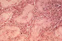 This photomicrograph reveals some of the histopathologic changes in a specimen of human testicular tissue, which included a large number of “foam cells”. These changes were attributed to a case of multibacillary (MB) leprosy.