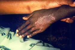 This patient presented to a clinical setting with an active cutaneous lesion on the left hand, which was determined to be due to paucibacillary Hansen’s disease. 