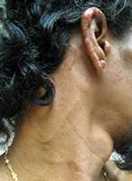 Visible enlargement of the great auricular nerve due to infection with M. leprae