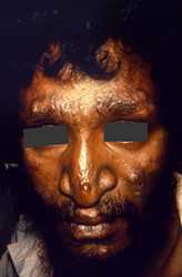 The face of this male patient exhibited some of the pathologic characteristic associated with a case of nodular lepromatous, or multibacillary (MB), Hansen’s disease. Of note is the presence of cutaneous nodules upon the forehead, nose, cheeks, lips, and chin. The eyebrows are diminished as well.