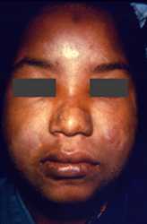 This young woman presented with a case of borderline Hansen’s disease with bilateral involvement of the patient’s buccinator, or cheek muscles, as well as dermatomyositis evidenced by the cutaneous rash-like discoloration overlying the muscles beneath. 