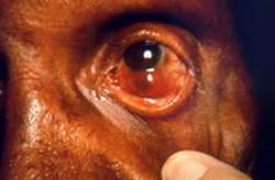 This patient presented in a clinical setting with a case of multibacillary leprosy. The photo shows one of the complications of this disease: staphyloma of the left eyeball. A staphyloma involves the protrusion of the wall of the eyeball, exhibiting a dark coloration due to the fact that the inner wall of the globe is pigmented and pushed towards its surface. This degeneration to the globe is a direct result of this illness.<