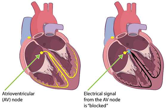 The cross-section of the heart on the left shows the electrical signals as they flow through a normal heart. The drawing on the right shows where the electrical signal can become blocked, causing heart block