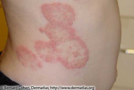 Five large red, raised ringworm rashes on persons 