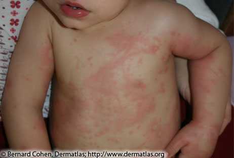 red splotchy rash on the torso and arms of a toddler