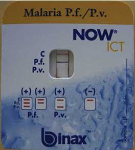 Binax NOW is the only brand of malaria RDT approved for use in the United States. The picture above demonstrates a positive test for Plasmodium falciparum. (Howden BP et al. Chronic falciparum malaria causing massive splenomegaly 9 years after leaving an endemic area. MJA 2005; 185: 186-188. ©Copyright 2005. The Medical Journal of Australia - reproduced with permission.)
