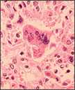 Histopatología de la neumonía por sarampión (célula gigante con inclusiones intracitoplasmáticas)