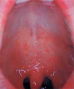 Boca de un paciente con manchas de Koplik, un primer signo de la infección por sarampión