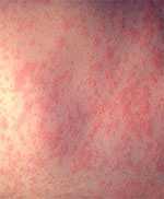 Image%26#37;20of measles infection