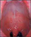 This was a patient who presented with Koplik’s spots on palate due to pre-eruptive measles on day 3 of the illness.