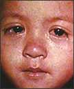 Ojos de un niño con sarampión