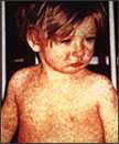 Niño con un clásico sarpullido del sarampión a los cuatro días