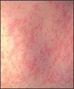 This is the skin of a patient after 3 days of measles infection.