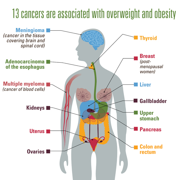 Illustration of human body displaying organs and labels for the 13 kinds of cancer related to overweight and obesity.