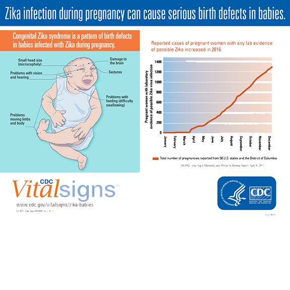 Infographic: Zika infection during pregnancy can cause serious birth defects in babies.