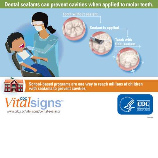 Dental sealants can prevent cavities when applied to molar teeth.
