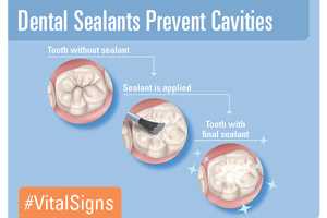 Dental Sealants Prevent Cavities