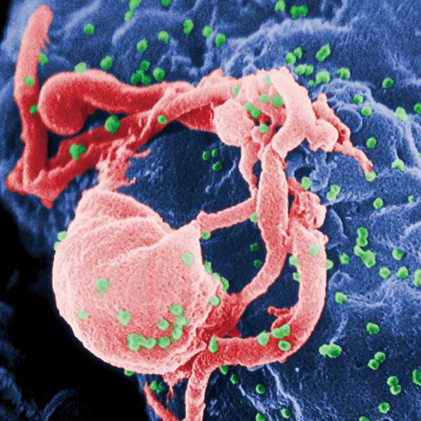 This scanning electron micrograph revealed the presence of the human immunodeficiency virus (HIV)