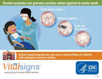 Infographic showing illustrations of molar teeth before and after sealants are applied