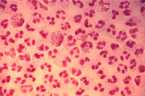 Microscopic image of gonorrhea