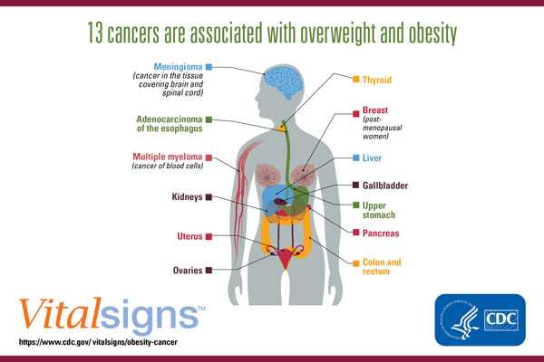 13 cancers are associated with overweight and obesity