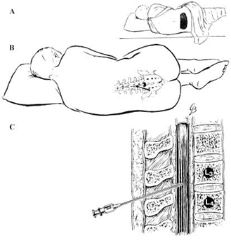 Figure 2 is a diagram showing how to collect cerebrospinal fluid (CSF) via lumbar puncture.” If you want to edit, go ahead.