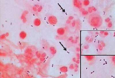 Figure 2 is a picture of a gram stain of S. pneumoniae with white blood cells (WBCs).