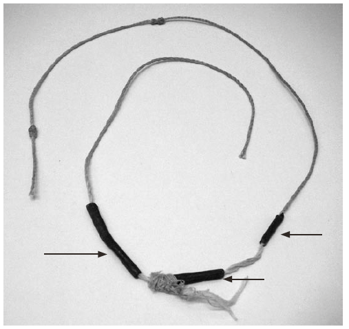 The figure shows an amulet with leaded beads made in Cambodia, similar to one worn by a lead-poisoned child in New York City in 2009