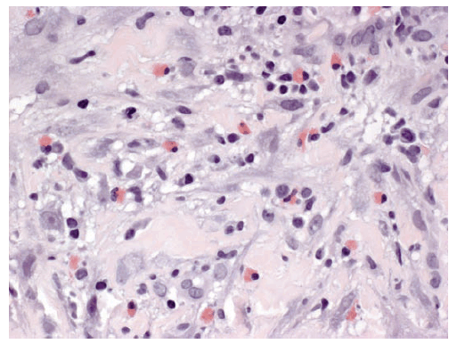 The figure above shows eosinophils observed in breast biopsy tissue from a patient with idiopathic granulomatous mastitis in Indianapolis, Indiana, in 2009.