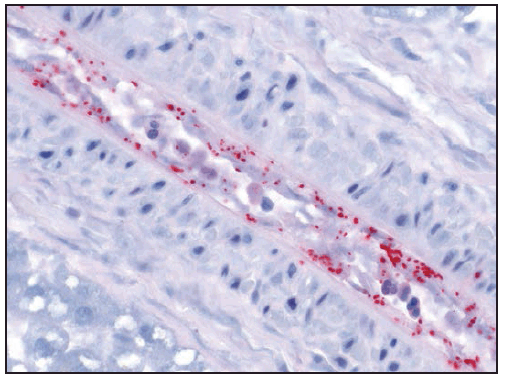This figure is a photograph showing an immunohistochemical stain demonstrating Rickettsia rickettsii (red) in infection of blood vessel endothelial cells.