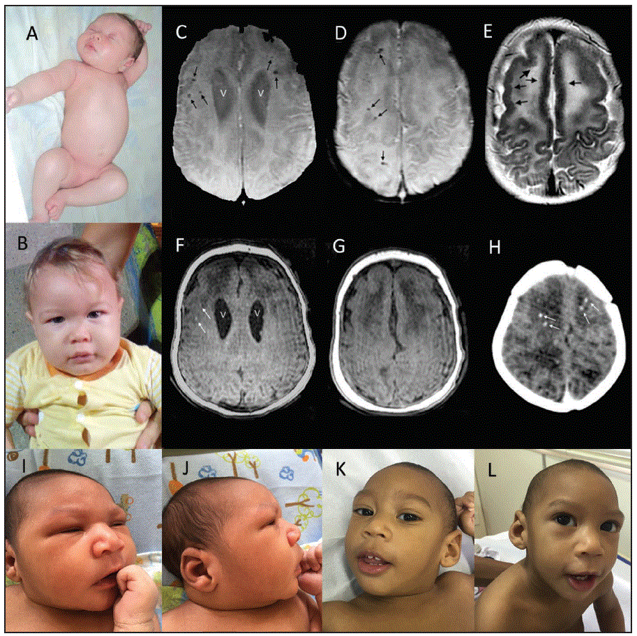 La figura de arriba es un compilado de fotografías clínicas, resonancias magnéticas y tomografías computarizadas de dos bebés de Brasil con síndrome congénito por el virus del Zika realizadas entre octubre del 2015 y octubre del 2016.
